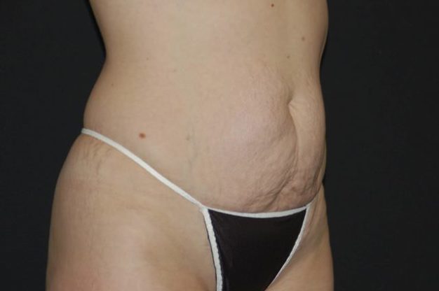 Abdomen before abdominoplasty