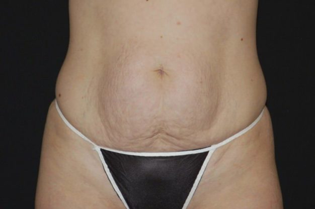 Front view of abdomen before abdominoplasty