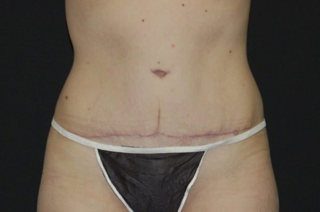 Front view of abdomen after abdominoplasty