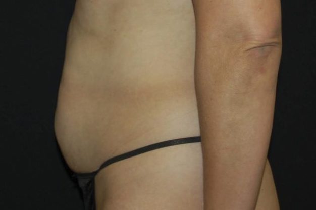 Side view of abdomen before abdominoplasty