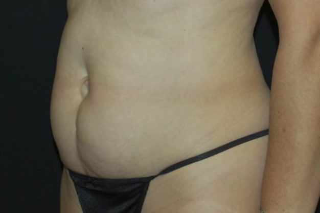 Abdomen before abdominoplasty surgery