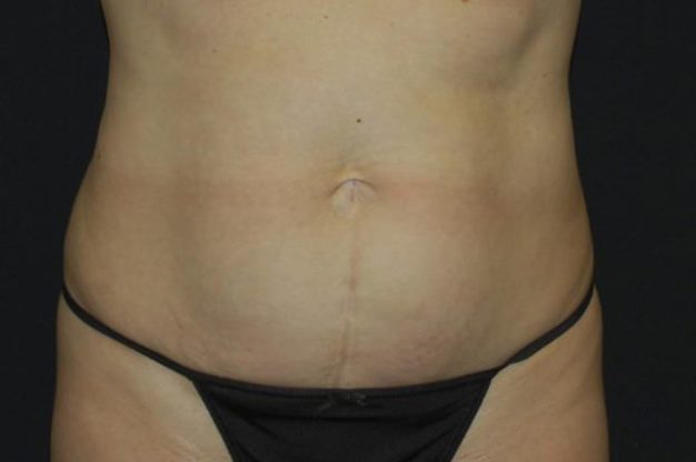 Front view of abdomen before abdominoplasty