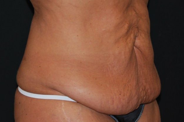 Side view of abdomen with excess skin before abdominoplasty