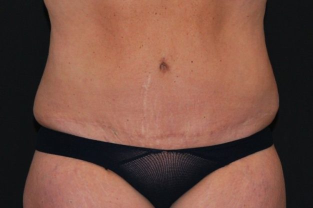 Front view of abdomen after abdominoplasty