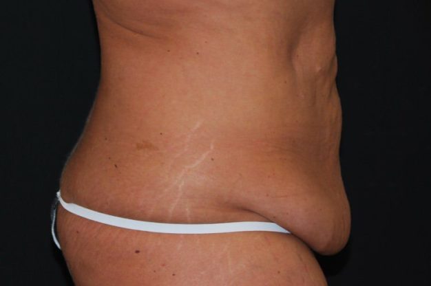 Side view of abdomen with loose skin before abdominoplasty