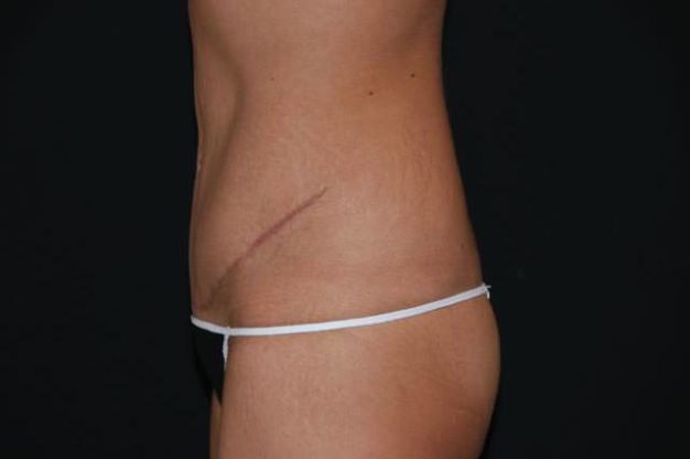 Side view of abdomen after abdominoplasty