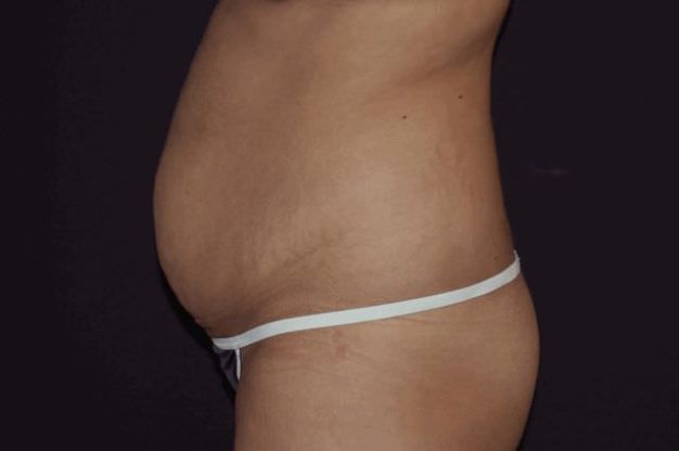 Side view of abdomen and excess skin before abdominoplasty