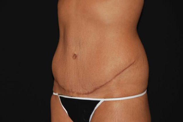 Abdomen after abdominoplasty surgery for excess skin