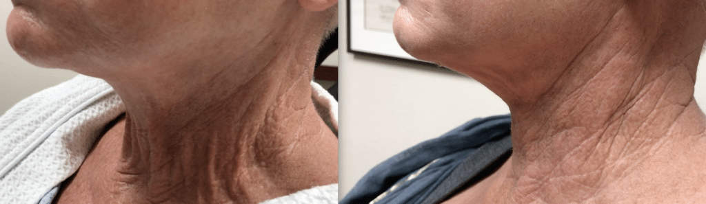 neck lift patient before and after